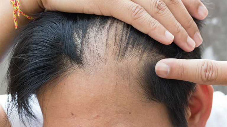 Rụng tóc hình đồng xu là gì? Nguyên nhân và cách điều trị