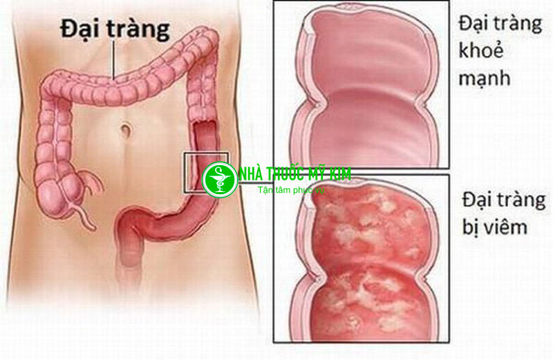 Bệnh viêm đại tràng là gì ? Các dấu hiệu nhận biết bệnh viêm đại tràng