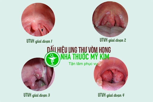 Bệnh Ung thư vòm họng là gì? Nguyên nhân- Triệu chứng- Cách điều trị bệnh