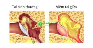 Bệnh viêm tai giữa là gì? Nguyên nhân dấu hiệu và cách điều trị bệnh viêm tai giữa