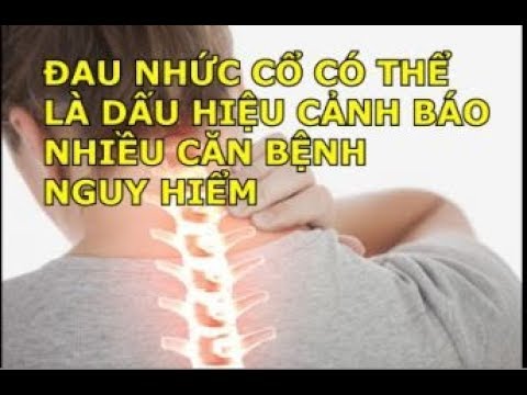 Sơ đồ minh họa các dấu hiệu đau cổ vai gáy lan xuống cánh tay do chèn ép thần kinh.