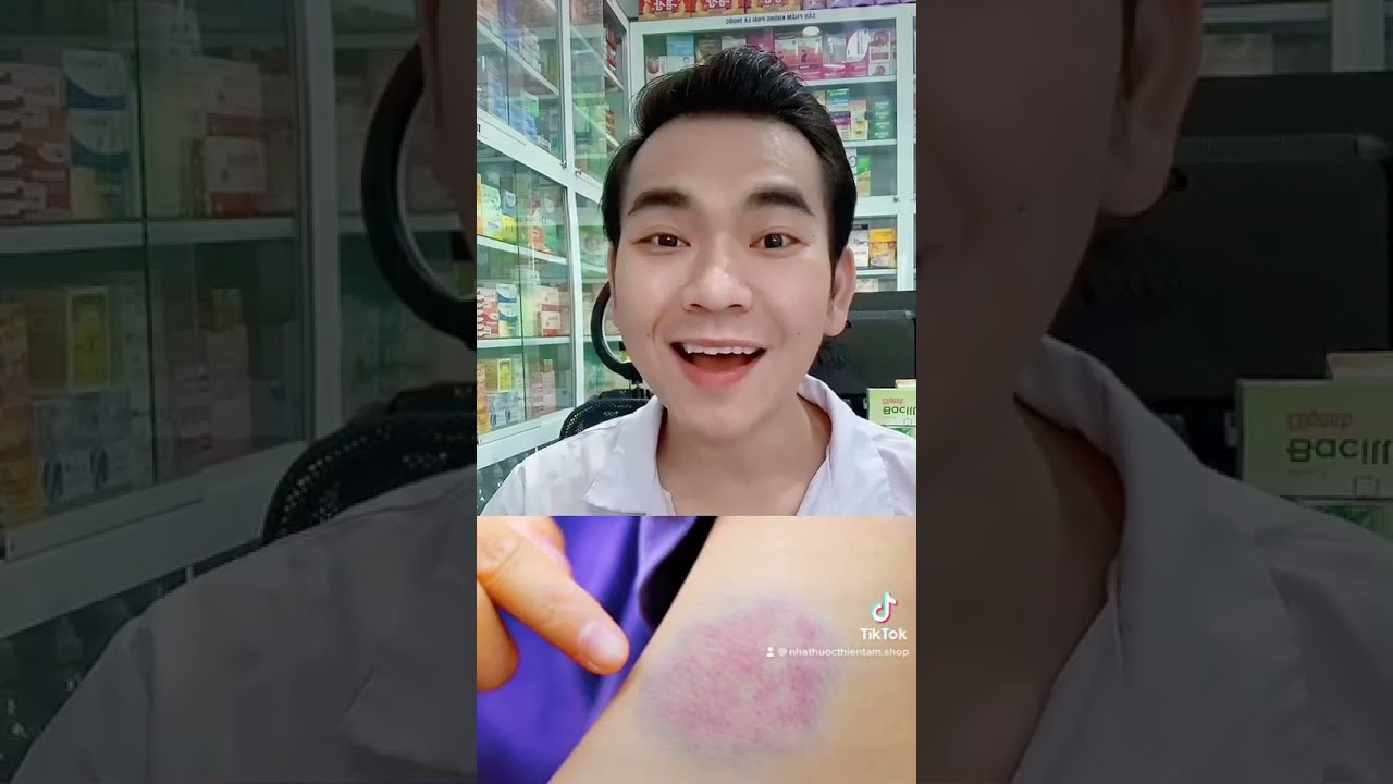 Ảnh minh họa các nguyên nhân gây bầm tím ban đêm và lời khuyên từ chuyên gia y khoa.