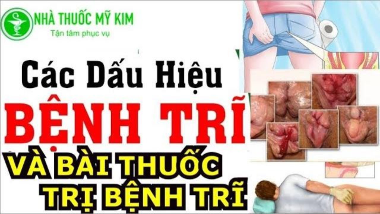 Hình minh họa các triệu chứng nhận biết bệnh trĩ nội và trĩ ngoại.