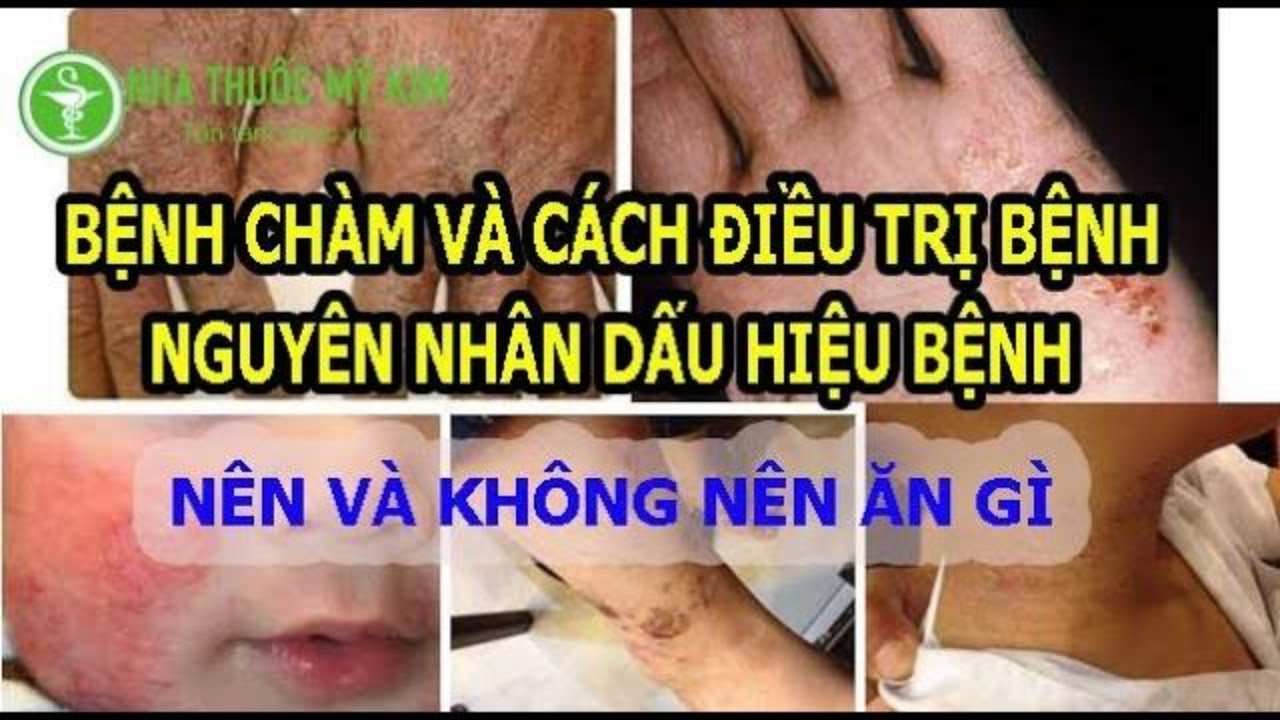 Ảnh minh họa bệnh chàm, da khô và cách chăm sóc da liễu chuyên nghiệp.