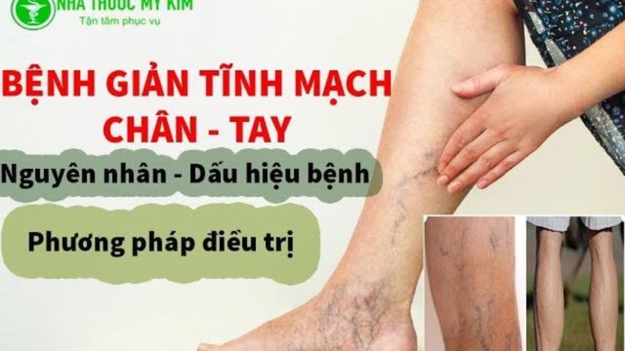 Hình ảnh minh họa về bệnh suy giãn tĩnh mạch và quy trình điều trị mạch máu.