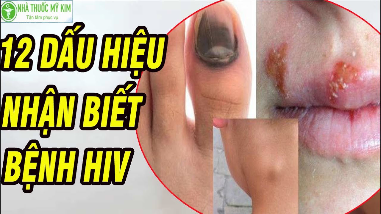 hình ảnh minh họa dấu hiệu nhận biết HIV và các triệu chứng đi kèm.