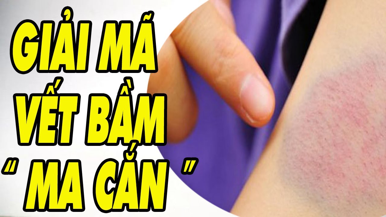 Hình ảnh minh họa các loại vết bầm tím và nguyên nhân bầm tím khi ngủ dậy do mao mạch vỡ.