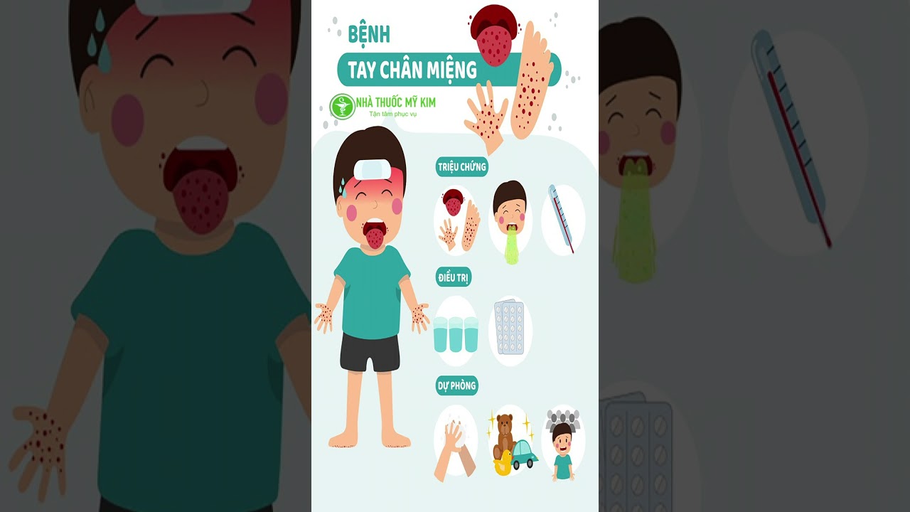 Triệu chứng và cách phòng tránh bệnh tay chân miệng ở trẻ em