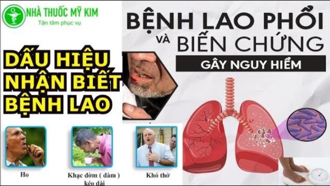 Hướng dẫn nhận biết triệu chứng và phòng ngừa bệnh lao phổi bằng hình ảnh minh họa.