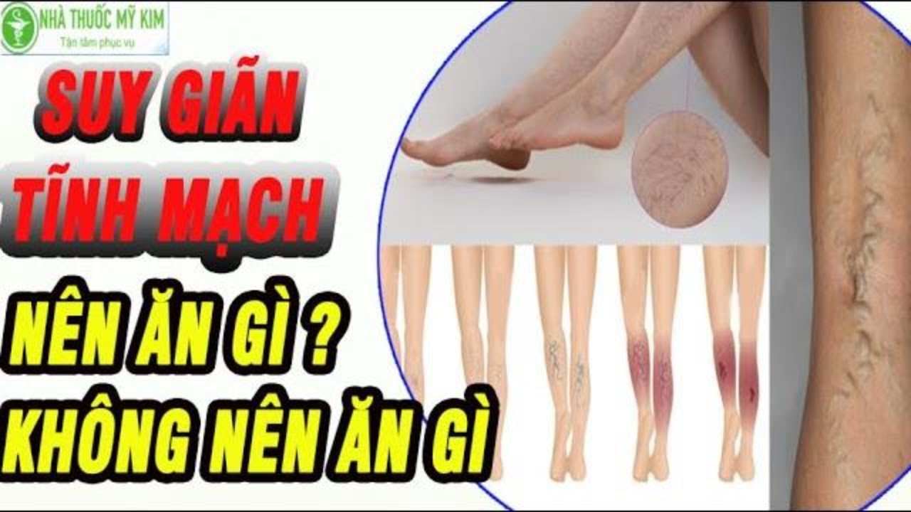 Bảng các loại thực phẩm hỗ trợ giảm triệu chứng suy giãn tĩnh mạch.