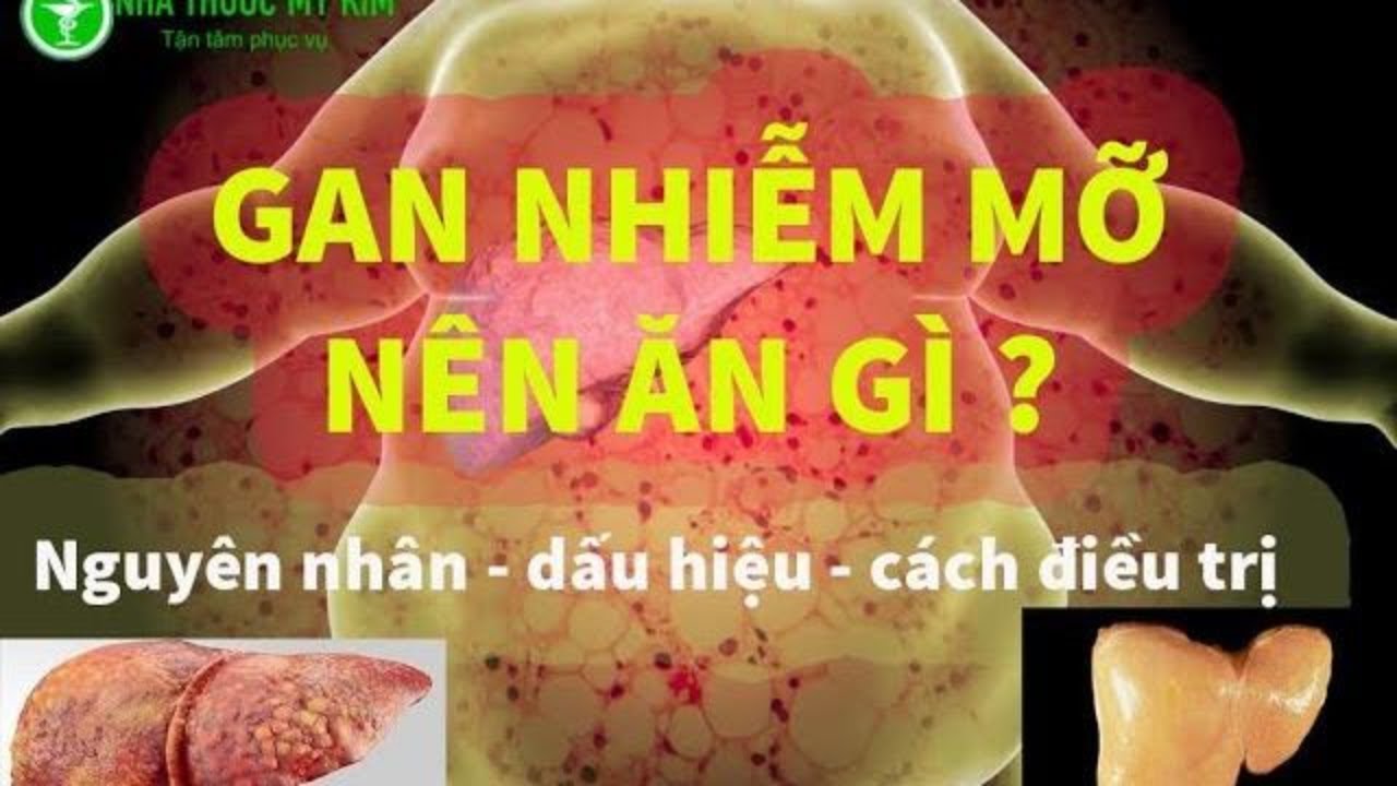 Sơ đồ mô phỏng cấu trúc gan nhiễm mỡ, các dấu hiệu nhận biết và hướng dẫn điều trị toàn diện.