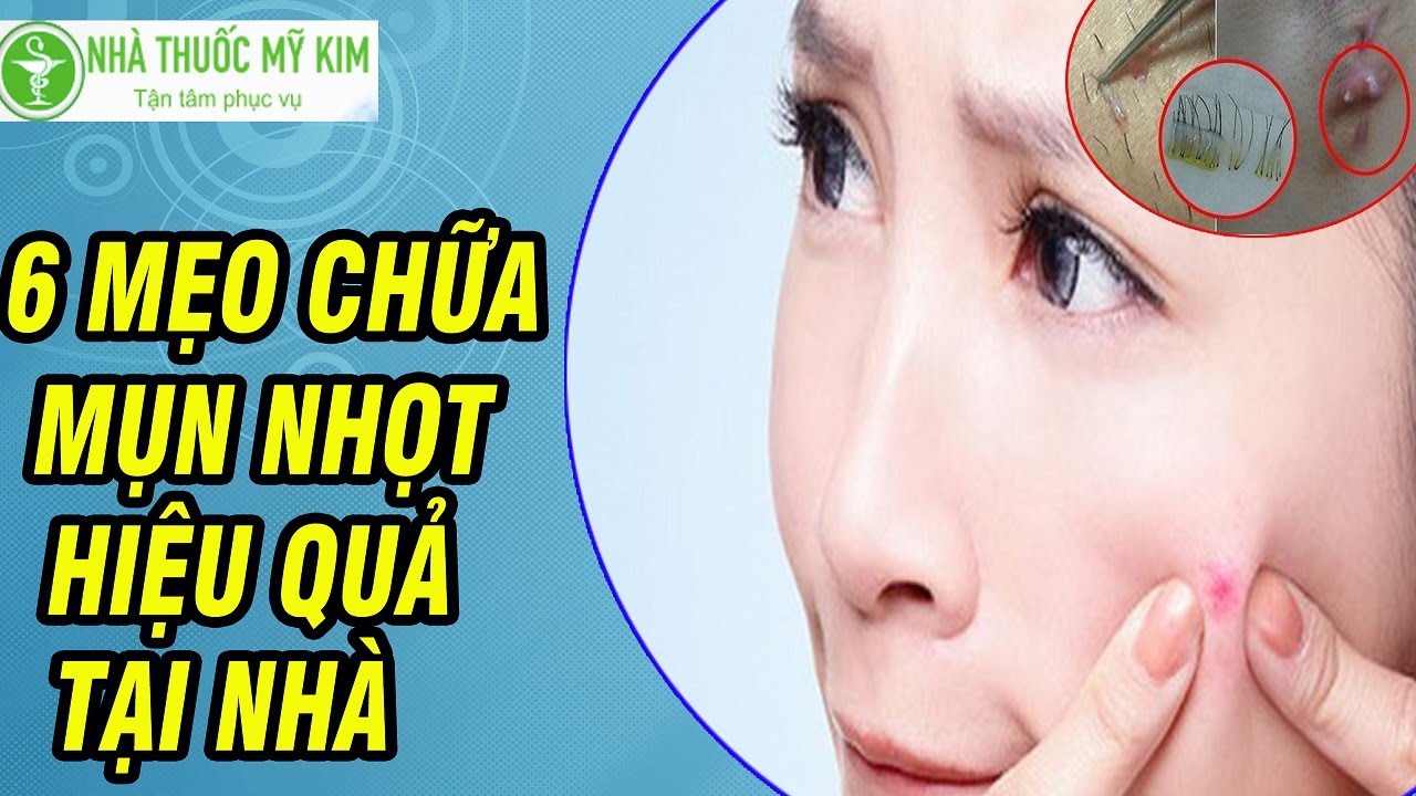 Hướng dẫn chăm sóc mụn nhọt an toàn tại nhà, phòng tránh nhiễm trùng và sẹo thâm.