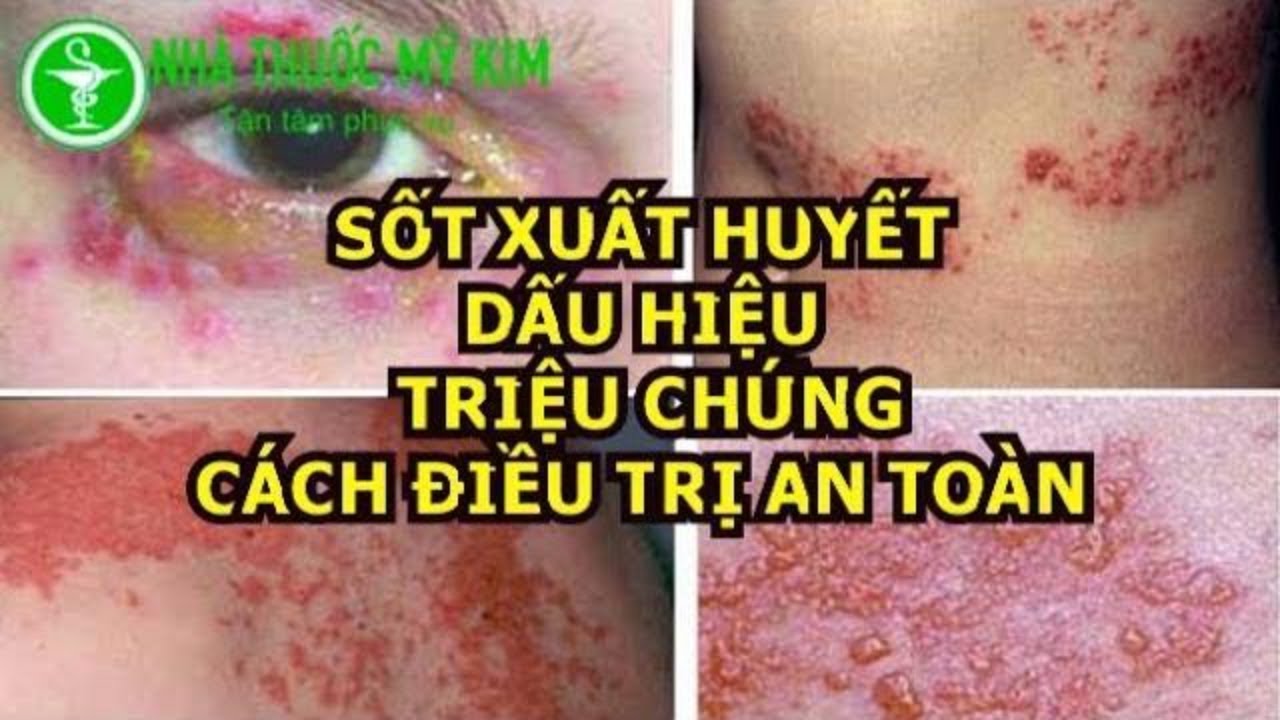 Bảng các dấu hiệu sốt xuất huyết nguy hiểm cần theo dõi y tế.