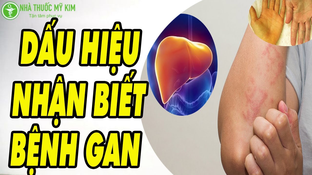 Minh họa về các dấu hiệu nhận biết bệnh gan và cơ chế tổn thương gan của cơ thể