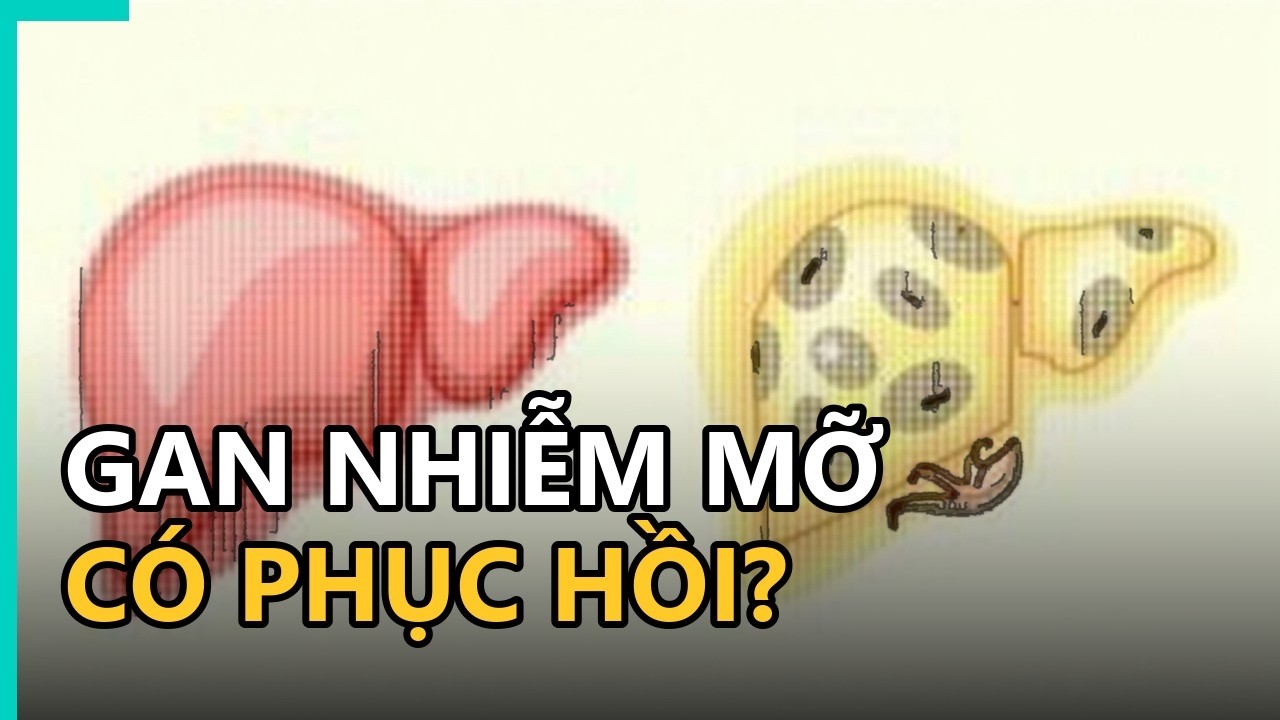Hướng dẫn điều trị gan nhiễm mỡ độ 1 bằng chế độ ăn uống và vận động lành mạnh.