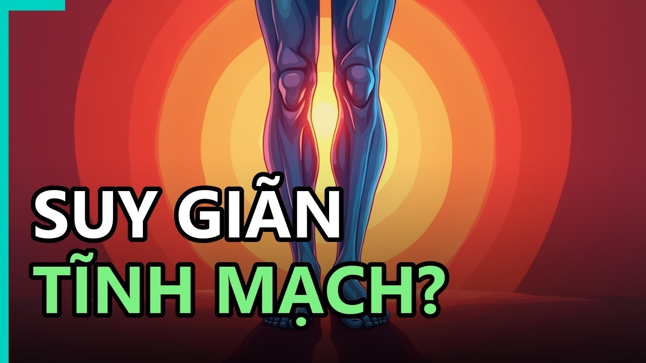 Hình ảnh minh họa dấu hiệu suy giãn tĩnh mạch, các đường gân xanh nổi rõ và vết bầm tím ở chân.