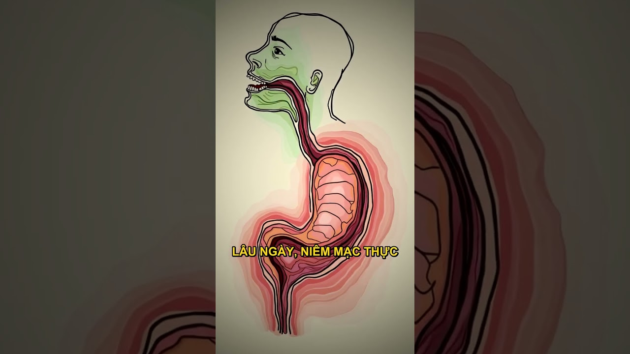 hình ảnh mô phỏng tình trạng nghẹn vướng ở cổ khi nuốt thức ăn
