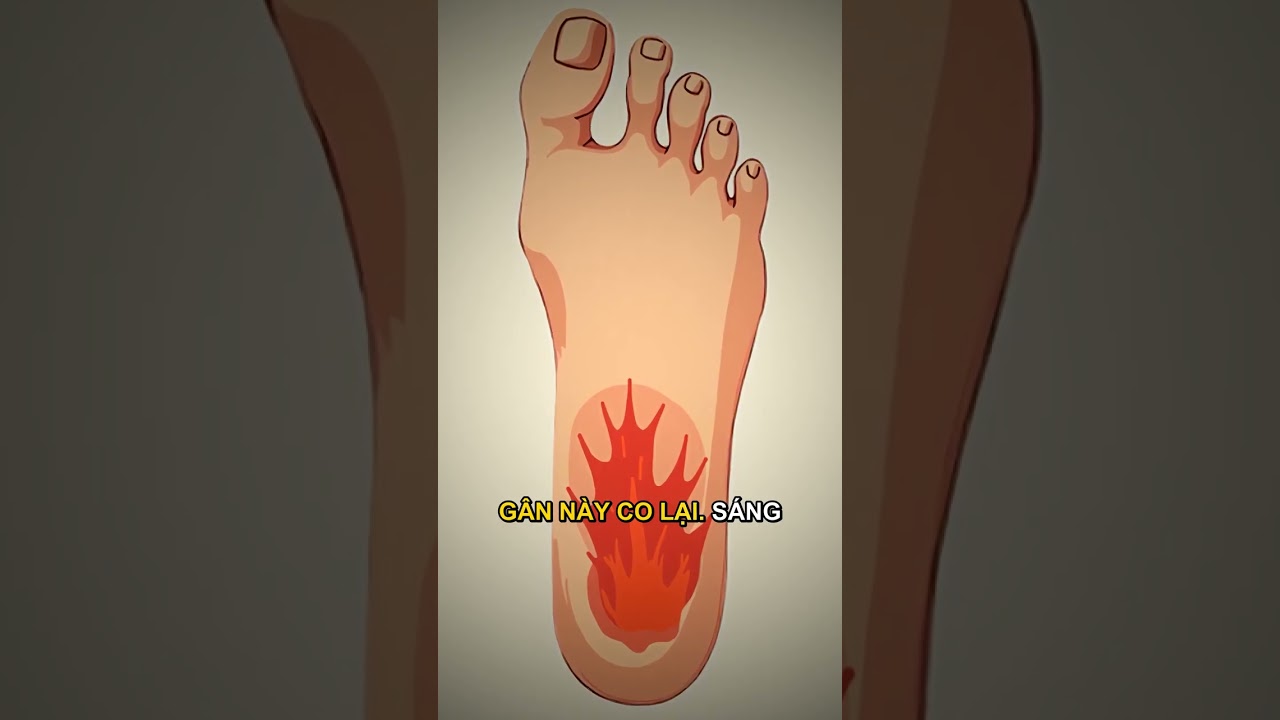 Hình ảnh minh họa tình trạng đau gót chân buổi sáng và cấu trúc cân gan chân.