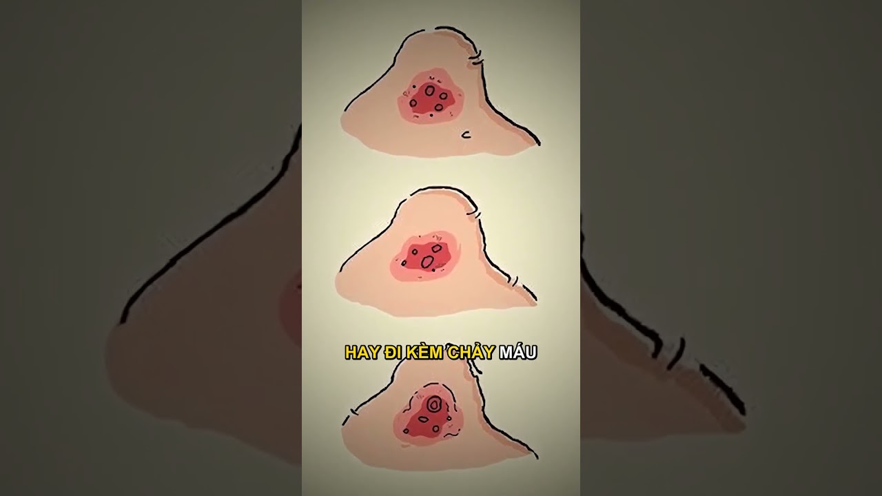 vết bầm tím không rõ va đập, nguyên nhân xuất huyết dưới da, chăm sóc mạch máu