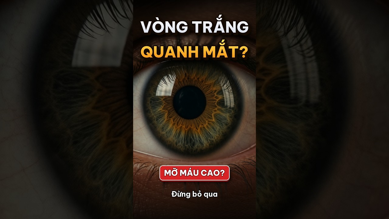 hình ảnh vòng trắng quanh tròng đen mắt do mỡ máu cao